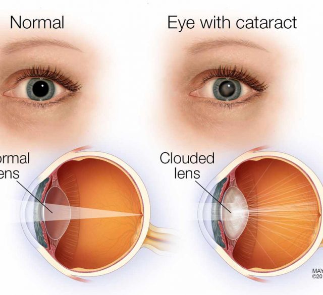normal-eye--cataract