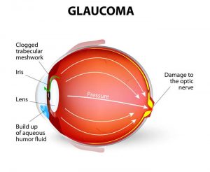 9710-glaucoma