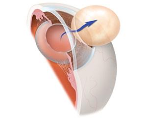 Cataract-surgery-illustration