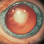 Congenital Cataract