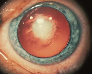 Congenital Cataract