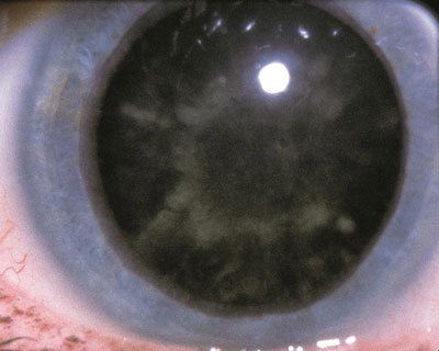 Diabetic Snowflake Cataract