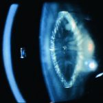 Lamellar or Zonular Cataract