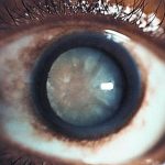 Mature Cataract