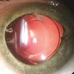 One Year After Cataract Surgery