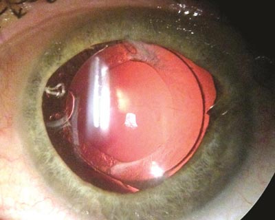 One Year After Cataract Surgery