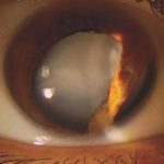 Traumatic Cataract