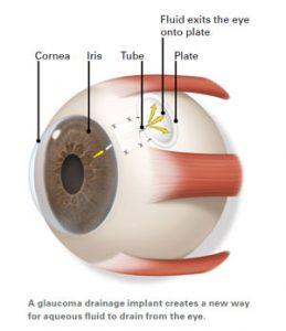 glaucoma_02