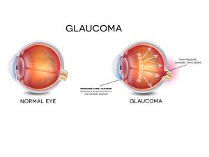 glaucoma_cover
