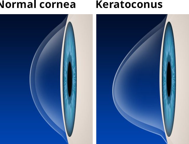 keratoconus-with-labels-660x488