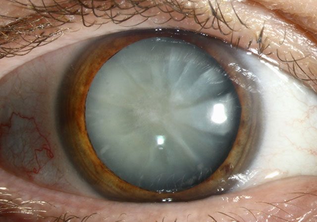cataract-drops