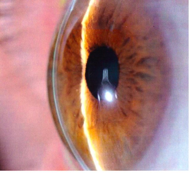 Descemet Stripping (automated) Endothelial Keratoplasty (DSEK/DSAEK)