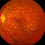 Modifiable Cardiovascular Risk Factors and Age-related Macular Degeneration
